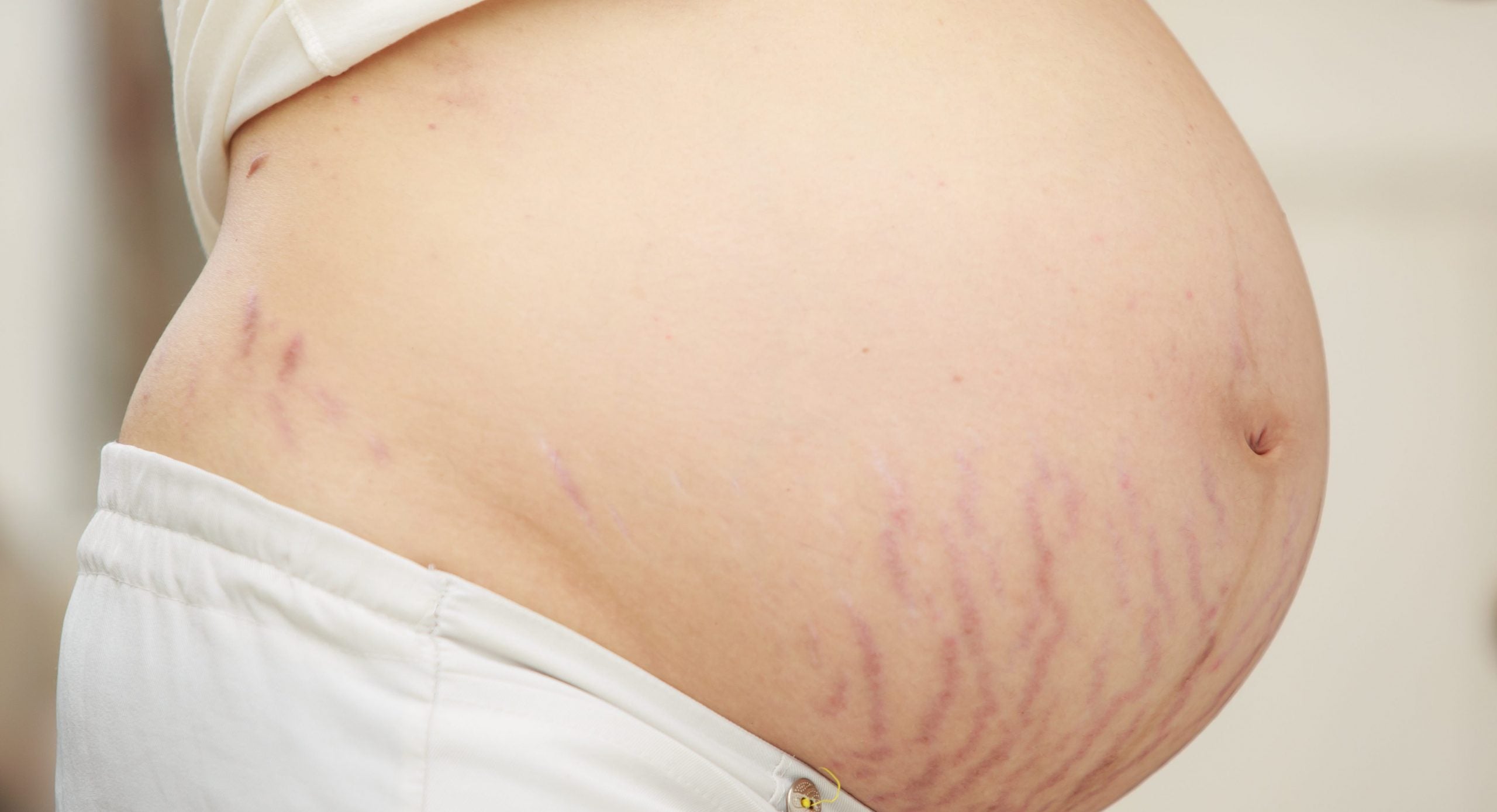 Strækmærker: Hvorfor kommer de, og hvad kan du gøre ved dem?