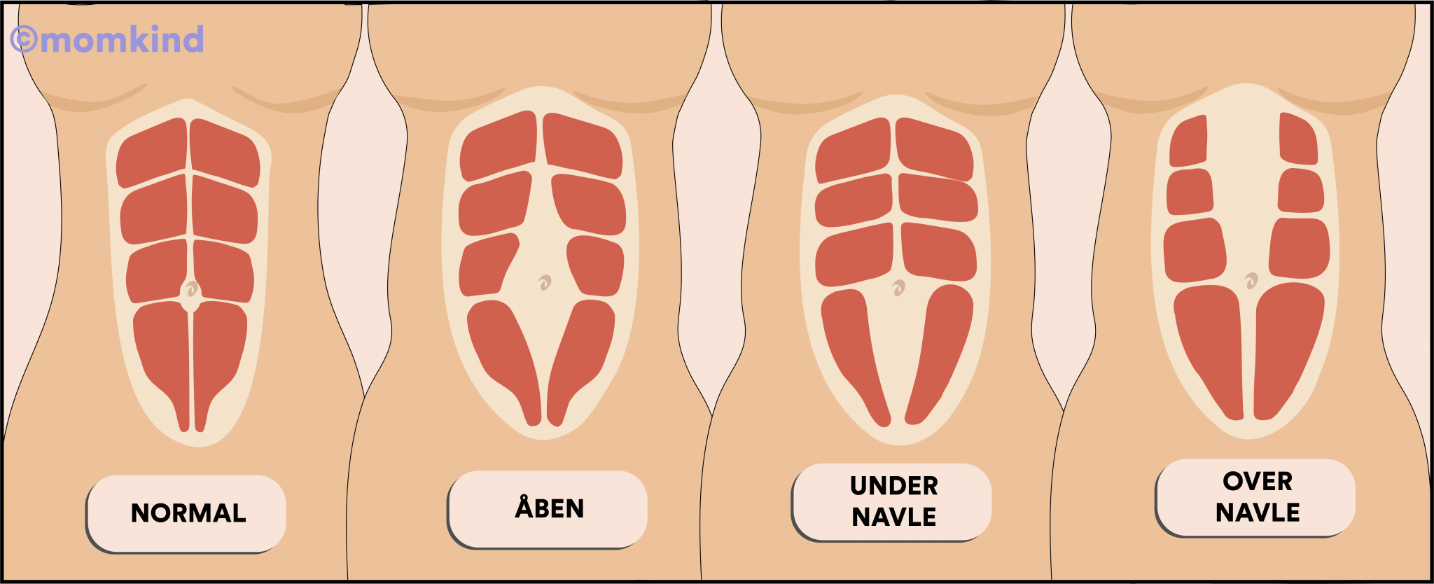 delte mavemuskler illustration viser rectus diastase
