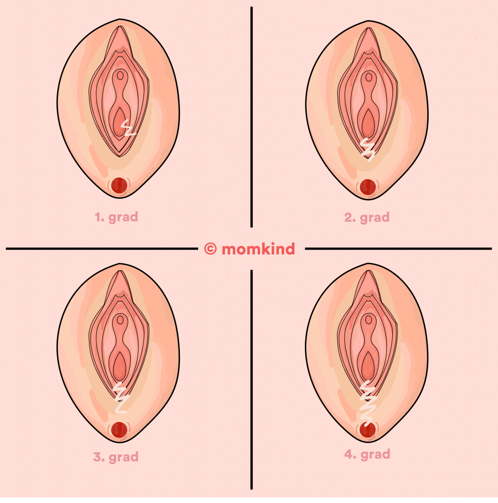 illustration der viser 4 grader af bristninger efter fødsel