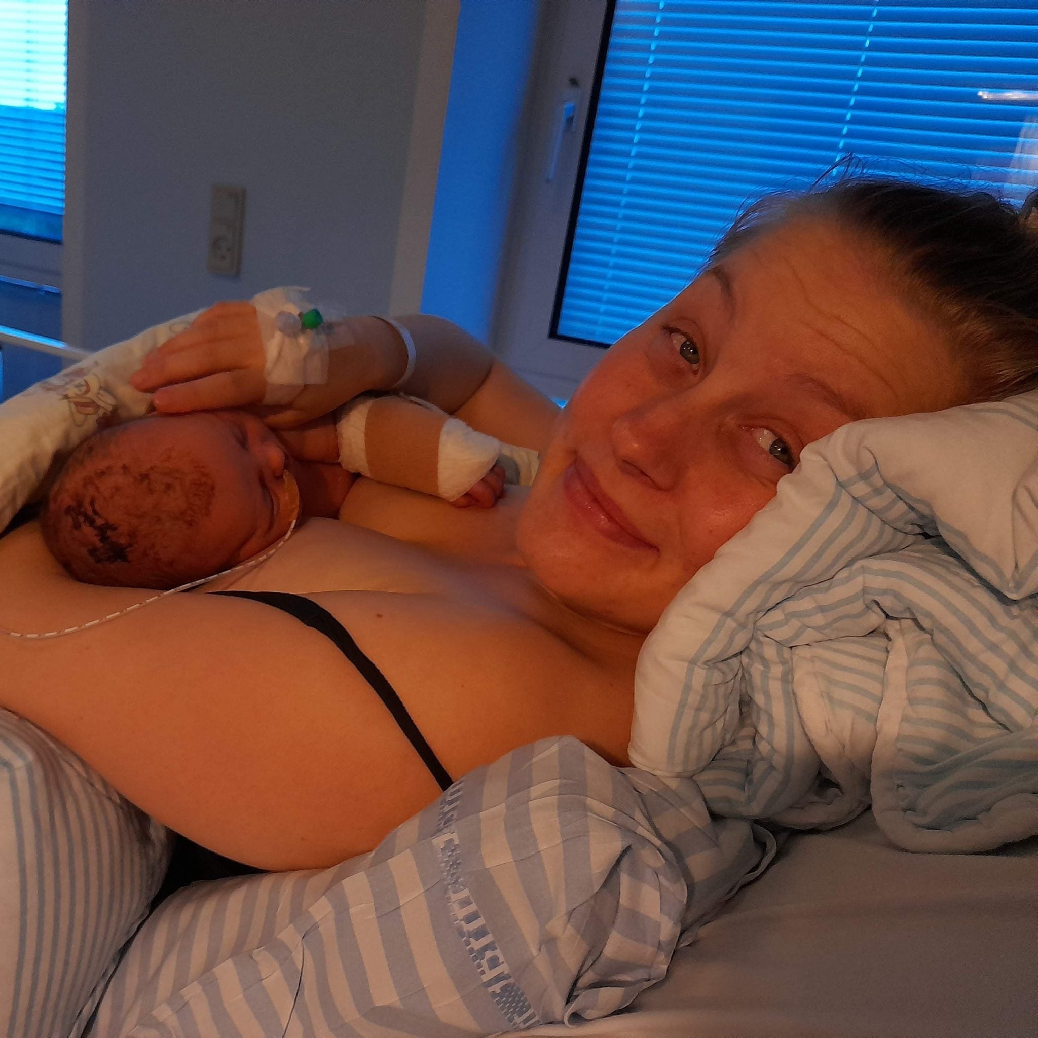 kejsersnit efter fødsel