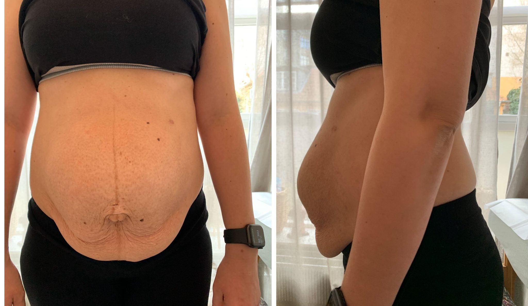 mave med delte mavemuskler rectus diastase