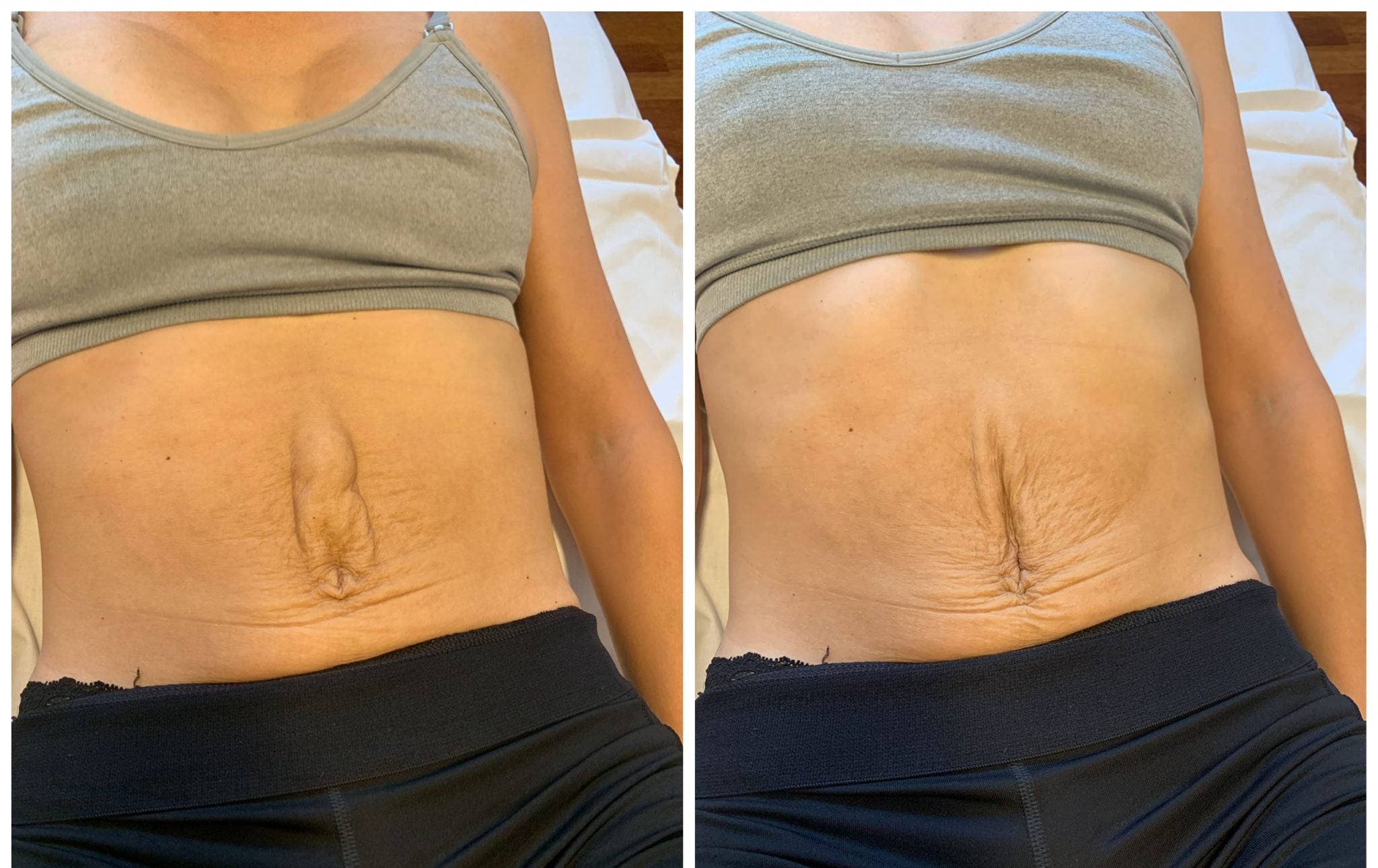 rectus diastase aktivering