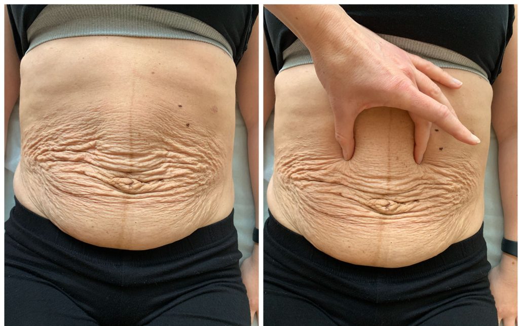 rectus diastase fingre viser mellemrum mellem muskler