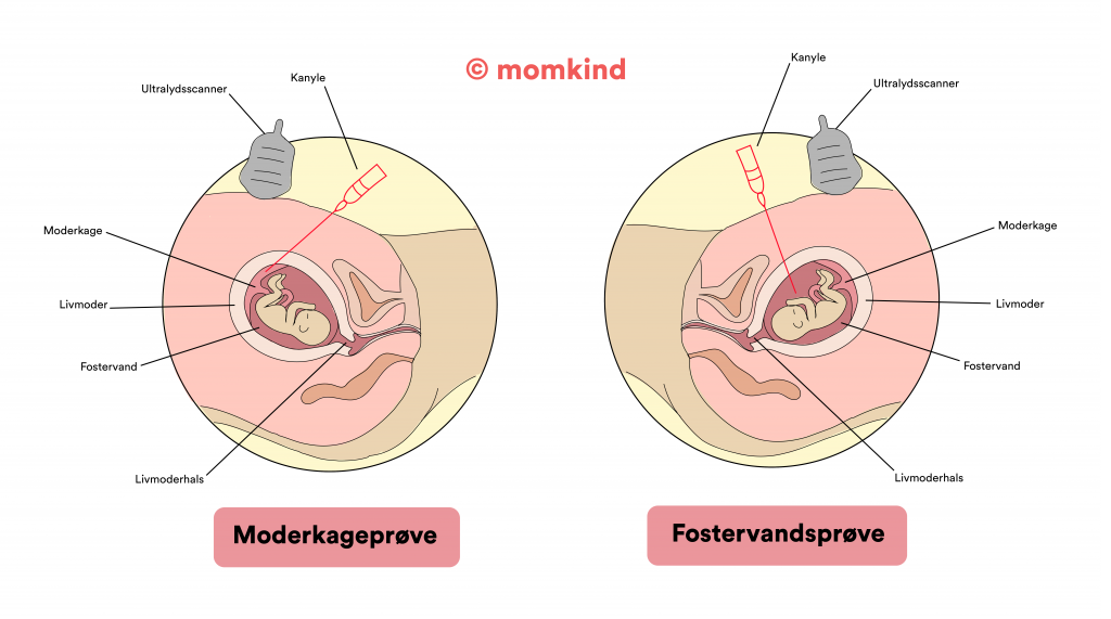 illustration af moderkageprøve og fostervandsprøve