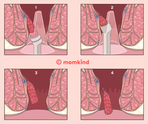 illustration viser hæmoride operation 