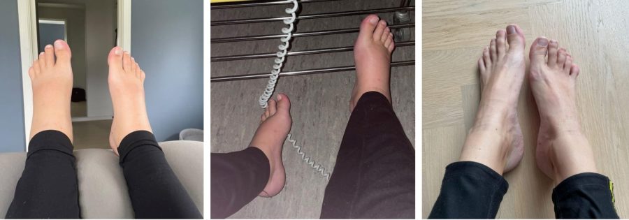 hævede fødder gravid