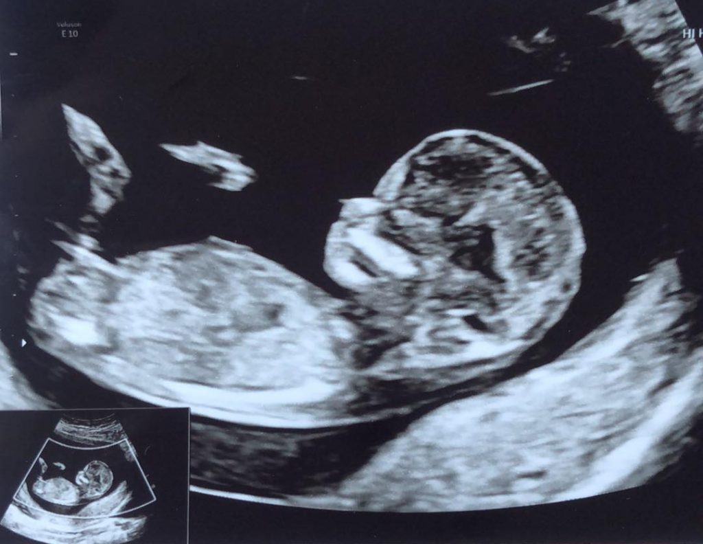 nub theory scanningsbillede pige